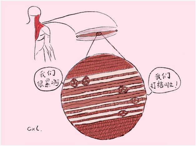 肌肉酸疼总不缓解?当心肌筋膜疼痛综合征